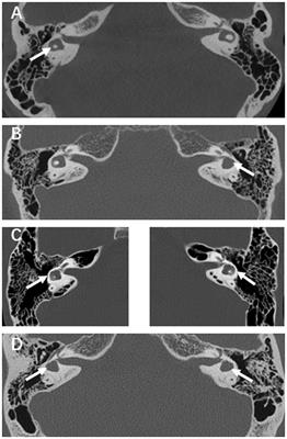 Prognostic changes after sudden deafness in patients with inner ear malformations characterized by LSCC: a retrospective study